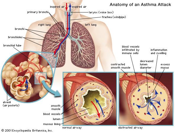 asthma-britannica